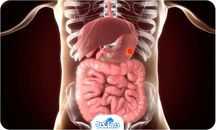 تشخیص سرطان معده در چند دقیقه + روش درمان