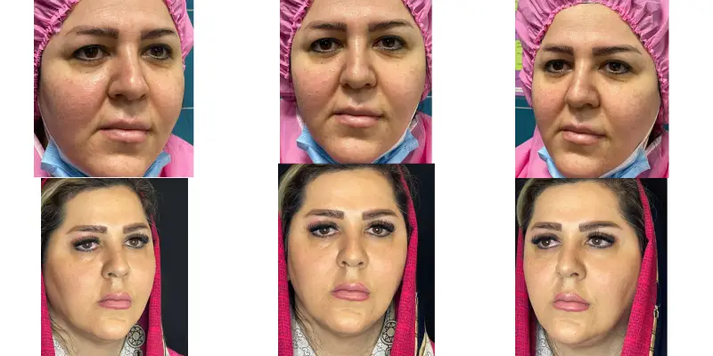 هزینه جراحی پلک، بهترین جراح پلک در تهران و چشم پزشک برتر