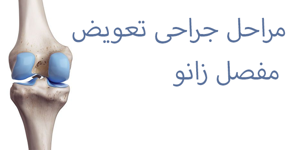 تعویض مفصل زانو؛ راهی نوین برای کاهش درد و بهبود کیفیت زندگی